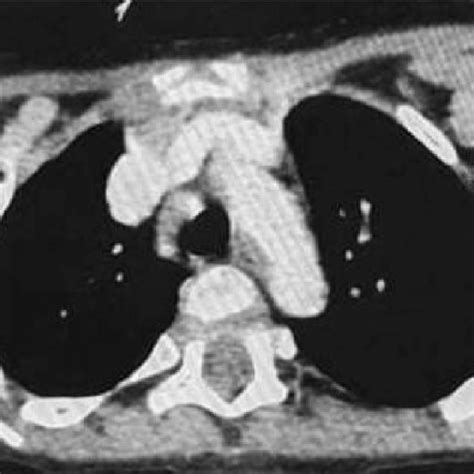 Ct Scan Chest Showing Multiple Enlarged Bilateral Supraclavicular 20