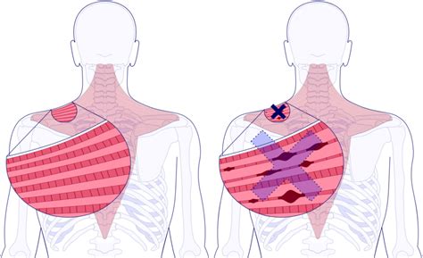 Proposed Trigger Point Anatomy Normal Left V Tense Right Muscle