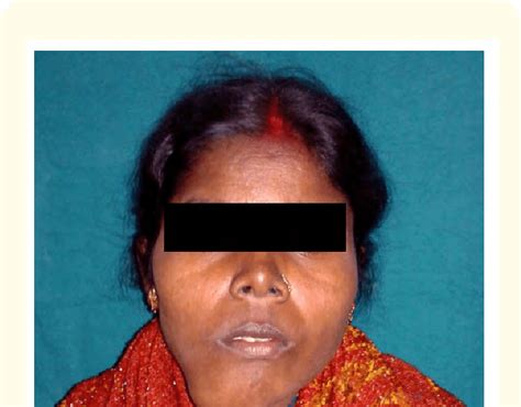 Extraoral Presentation Of The Swelling Showing Facial Asymmetry