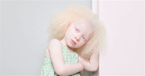 A Chronicle About Living With The Disorder Albinism Procaffenation