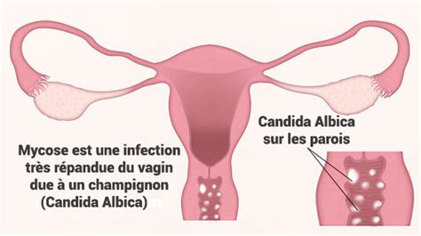 MYCOSE VAGINALE Santé des jeunes