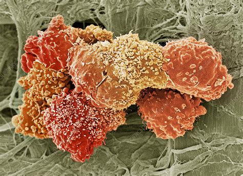 Teratoma Cancer Cells Sem Stock Image M1320928 Science Photo
