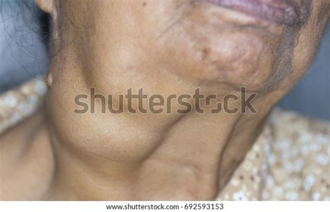 Zooming Closeup View Enlarged Submandibular Gland Stock Photo 692593153