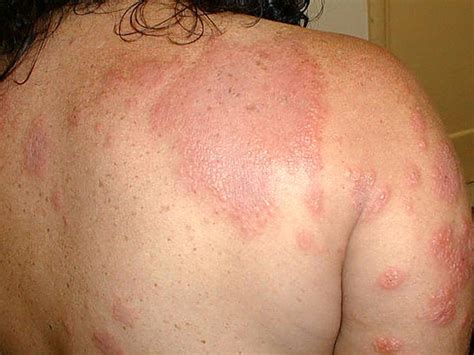 Skin Rashes And Cancer The Best Porn Website