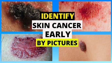 skin cancer pictures early stages types melanoma abcde criteria prevention youtube