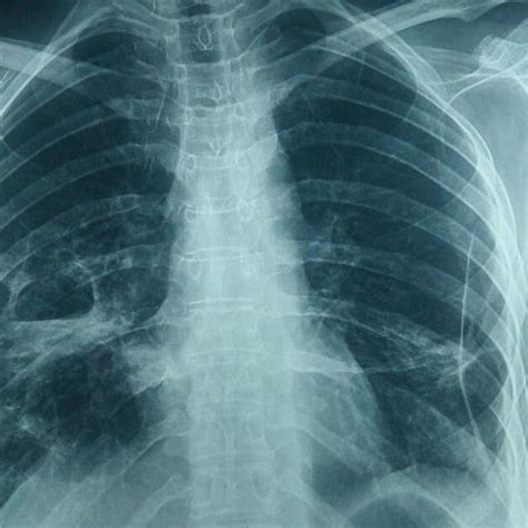 Follow Up Chest X Ray Of Patient Showing Resolution Of Lesions Left