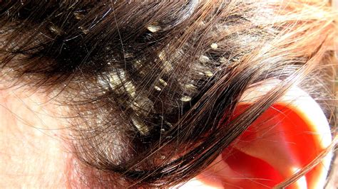 Home Remedy For Scalp Psoriasis Treatment Treat Choices