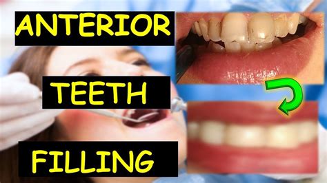Tooth Filling Composite Dental Filling Filling With Composite Front Teeth Filling Dental