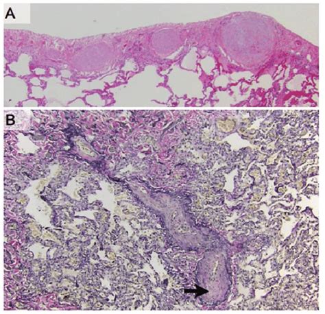 Pathologic Findings Revealed Pulmonary Veno Occlusive Disease A