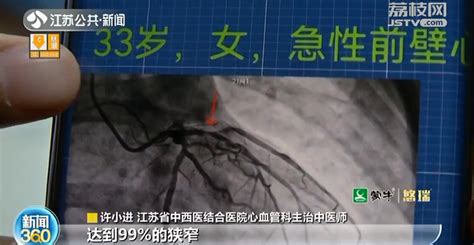 烟龄超10年 南京33岁女子牙疼伴呕吐被确诊为心梗 我苏网