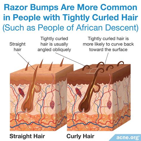 What Are Razor Bumps