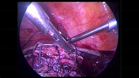 Convert between centimeters and feet and inches (cm and ft and in) using this calculator tool. laparoscopic myomectomy 9 cm fibroid GENESYS FERTILITY ...