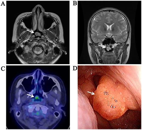 Thyroid Like Low Grade Nasopharyngeal Papillary Adenocarcinoma A Case