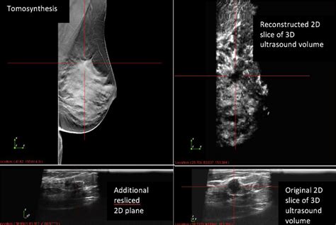 Mammographically And Sonographically Suspicious Lesion In The