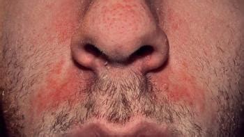 The face and trunk are the most commonly involved sites and usually correspond to the areas most affected by primary varicella. HIV rash: Types, other symptoms, changes
