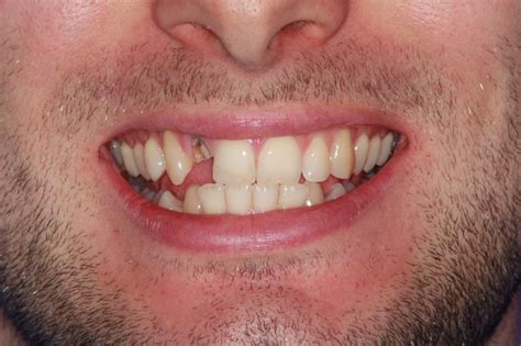 missing front teeth    dental implants