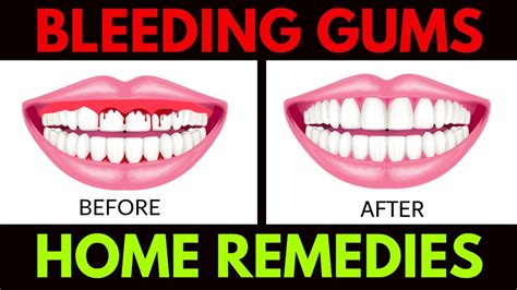 Bleeding Gums Home Remedies Treat Your Bleeding Gums At Home Youtube