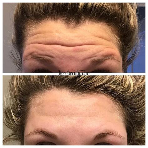 Botox Before And After My Botox Experience Botox Before And After