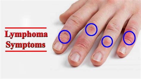 Lymphoma Types Causes Symptoms Diagnosis Treatment