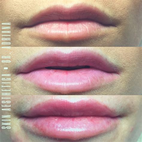 Plump Lips 1 Syringe Of Lip Filler Restylane By Dr Adriana At Skin