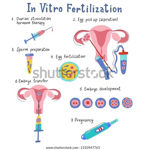 In Vitro Fertilization Infographic In Flat And Handdrawn Style With