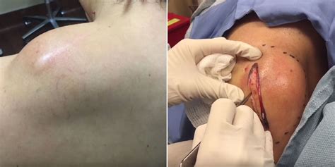 Watch Dr Pimple Popper Really Go To Town On This Melon Sized Fatty Mass