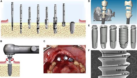 Frontiers A Brief Review On The Evolution Of Metallic Dental Implants History Design And