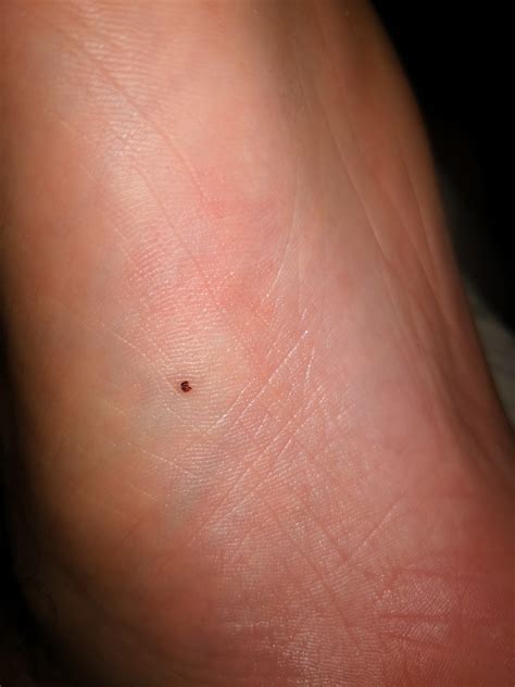 Melanoma On Buttom Of My Foot Diagnoseme