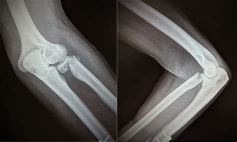 Radial Neck Fracture Nonunion A Case Report And Novel Fixation
