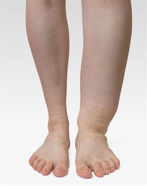 Leg Swelling And Lymphedema The Institute For Vein Health Peter Brukasz Md Addison Il