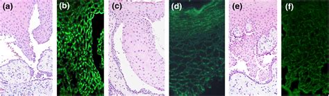 Histopathological And Direct Immunofluorescence Features Of Pemphigus