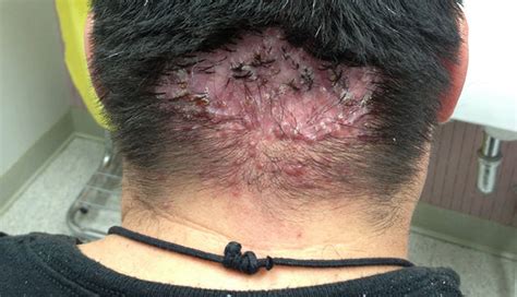 Cystic Acne On Scalp