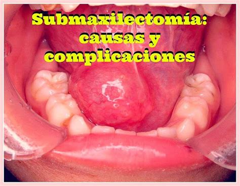 Pdf Submaxilectomía Causas Y Complicaciones Odontología Virtual