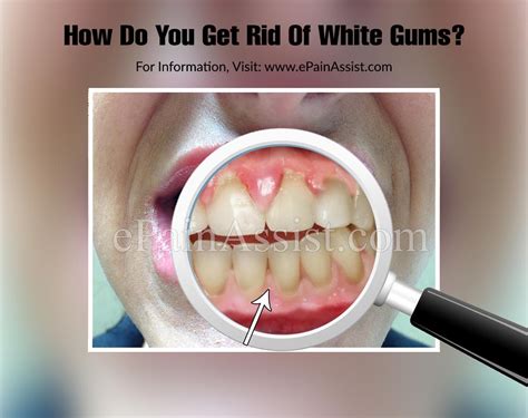 How Do You Get Rid Of White Gums