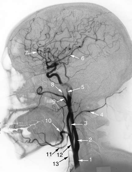 Medical School • Angiogram Of The Head Common Carotid Artery