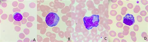 Peripheral Blood Smear Demonstration Of Lymphocyte Changes In Severe