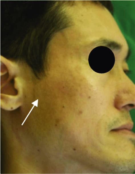 A Photograph Of The Patients Face Shows Slight Preauricular Swelling