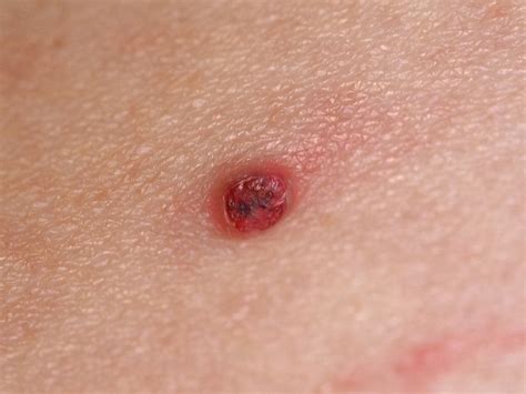 What Is Granuloma Annulare And How Can This Condition Be Helped