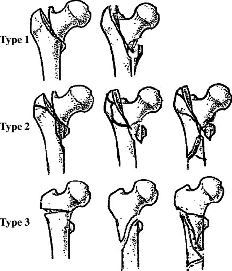 Types Of Femoral Fracture According To Their Location In The Proximal