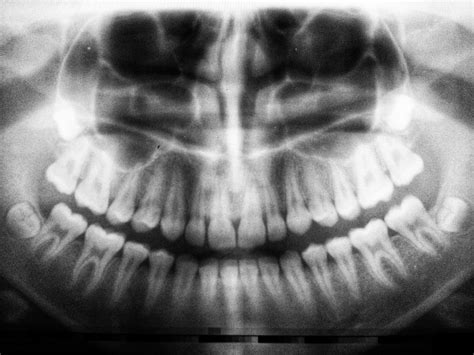 Scientists at the university of washington believe scrapping. Are Dental X-Rays Safe? - Southview Dentistry
