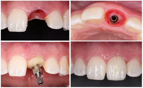 Ortodoncia vs implantes dentales año 2024 Clinica Nudent Trujillo