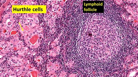 Hashimotos Thyroiditis Pathology Made Simple