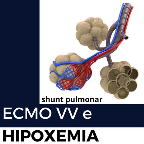 Shunt Pulmonar E Hipoxemia Na Ecmo Vv O Racional E A Conduta