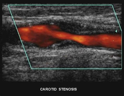 Carotid Stenosis Ultrasound SIFSOF