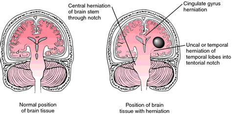 Tentorial Herniation Definition Of Tentorial Herniation By Medical