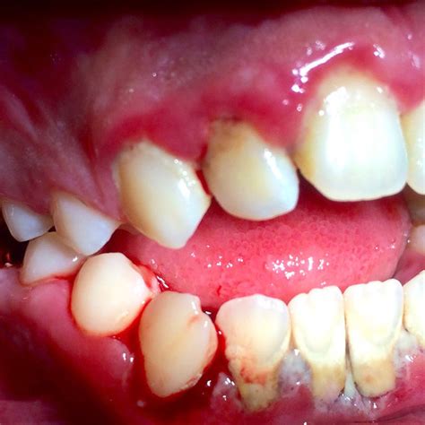 Spontaneous Gingival Bleeding Gingival Pain And Multiple Caries