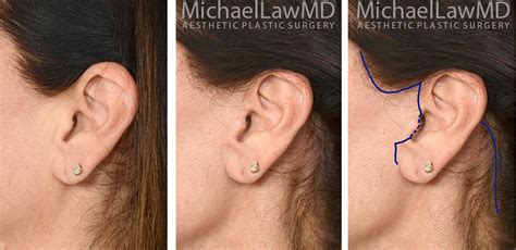 Facelift Scar Photo Gallery