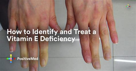 How To Identify And Treat A Vitamin E Deficiency Positivemed