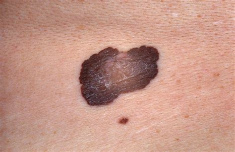 Skin Cancer Photos Melanoma