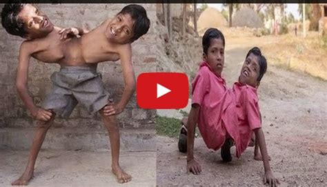 conjoined twins refuse to be separated must watch video